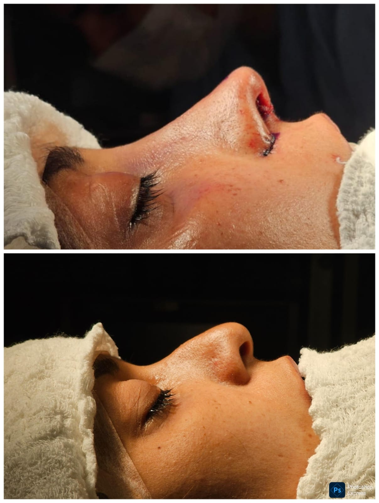 Resultado de rinoplastia — caso 1, antes e depois