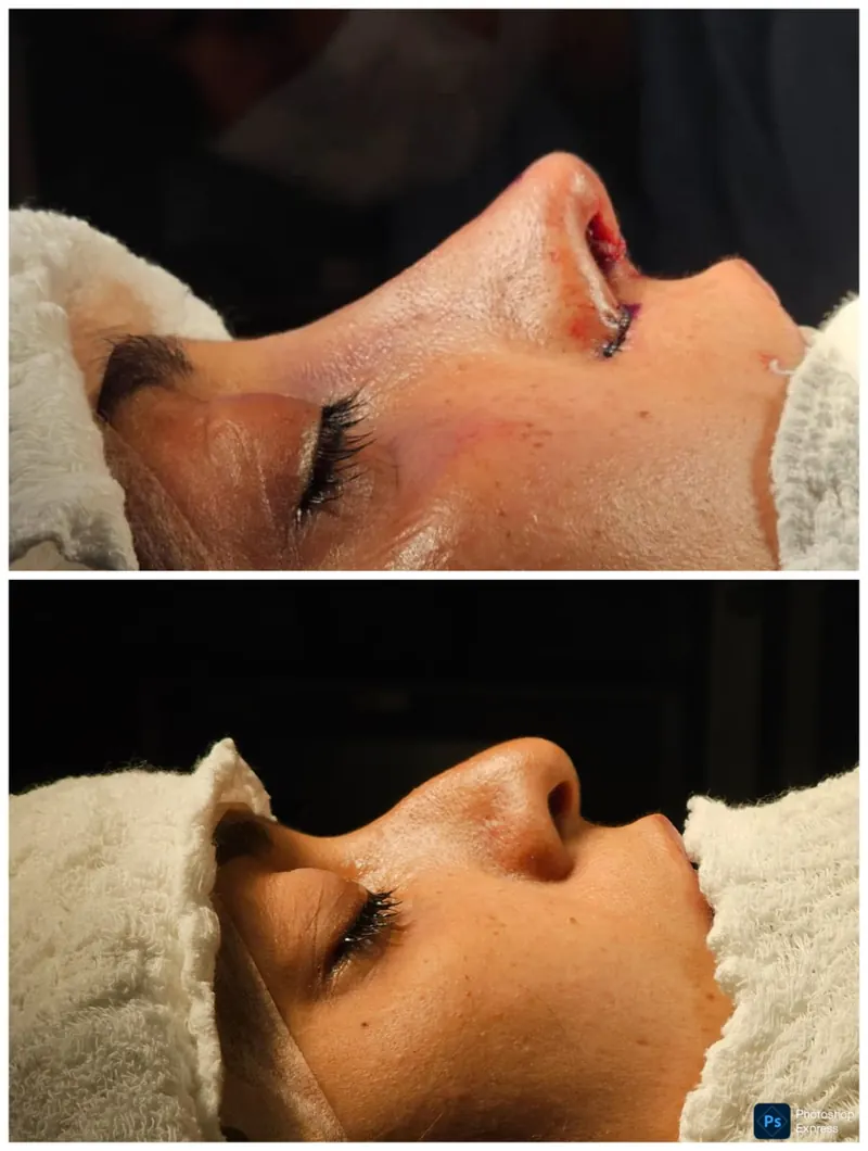 Resultado de rinoplastia — caso 1, antes e depois
