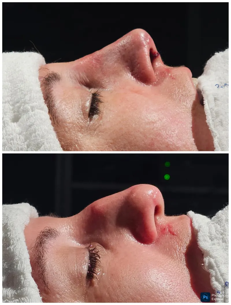 Resultado de rinoplastia — caso 2, antes e depois