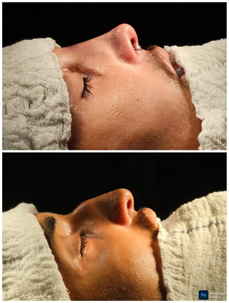 Resultado de rinoplastia — caso 4, antes e depois