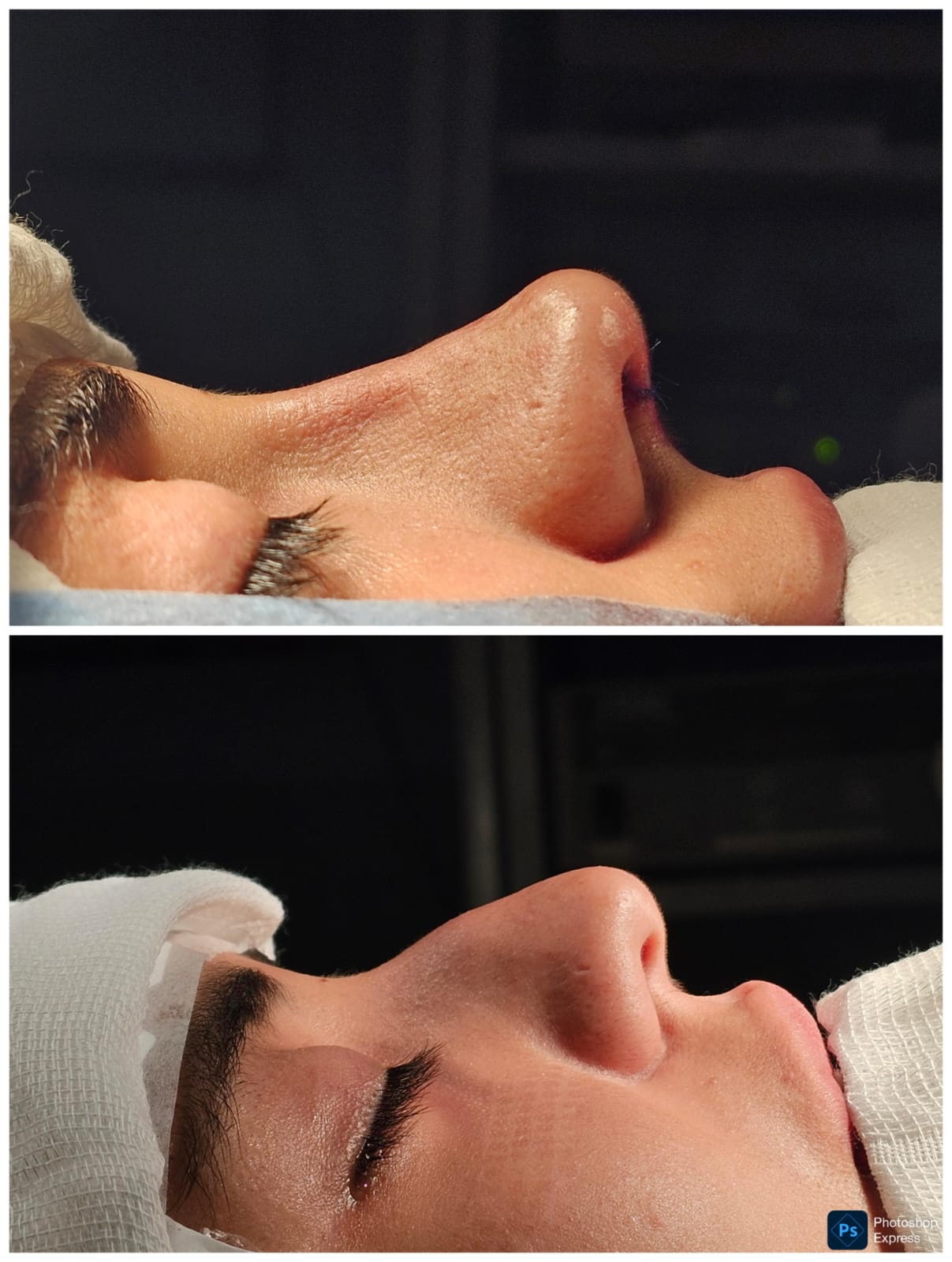 Resultado de rinoplastia — caso 5, antes e depois