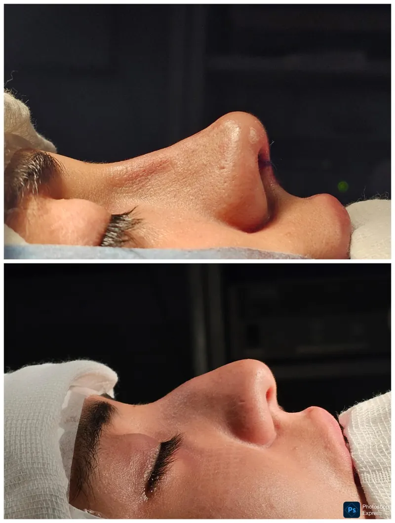 Resultado de rinoplastia — caso 5, antes e depois